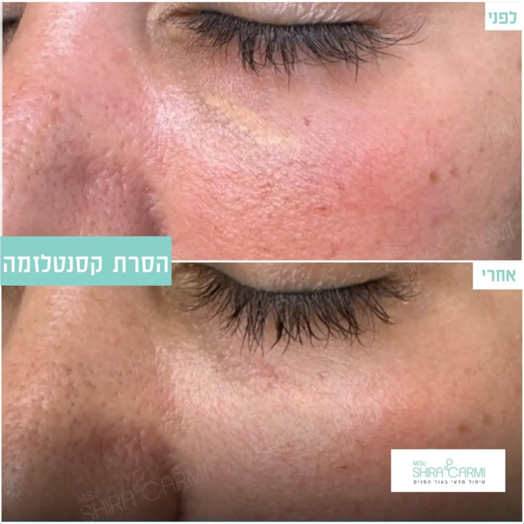 טיפול אנטי אייגינג טיפול פנים להצערת העור שירה כרמי קרית אונו
