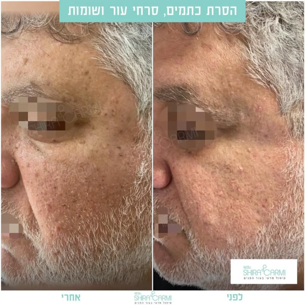 טיפול פלזמה למתיחר העור לפני אחרי טיפולי פלזמה שירה כרמי קוסמטיקאית רפואית