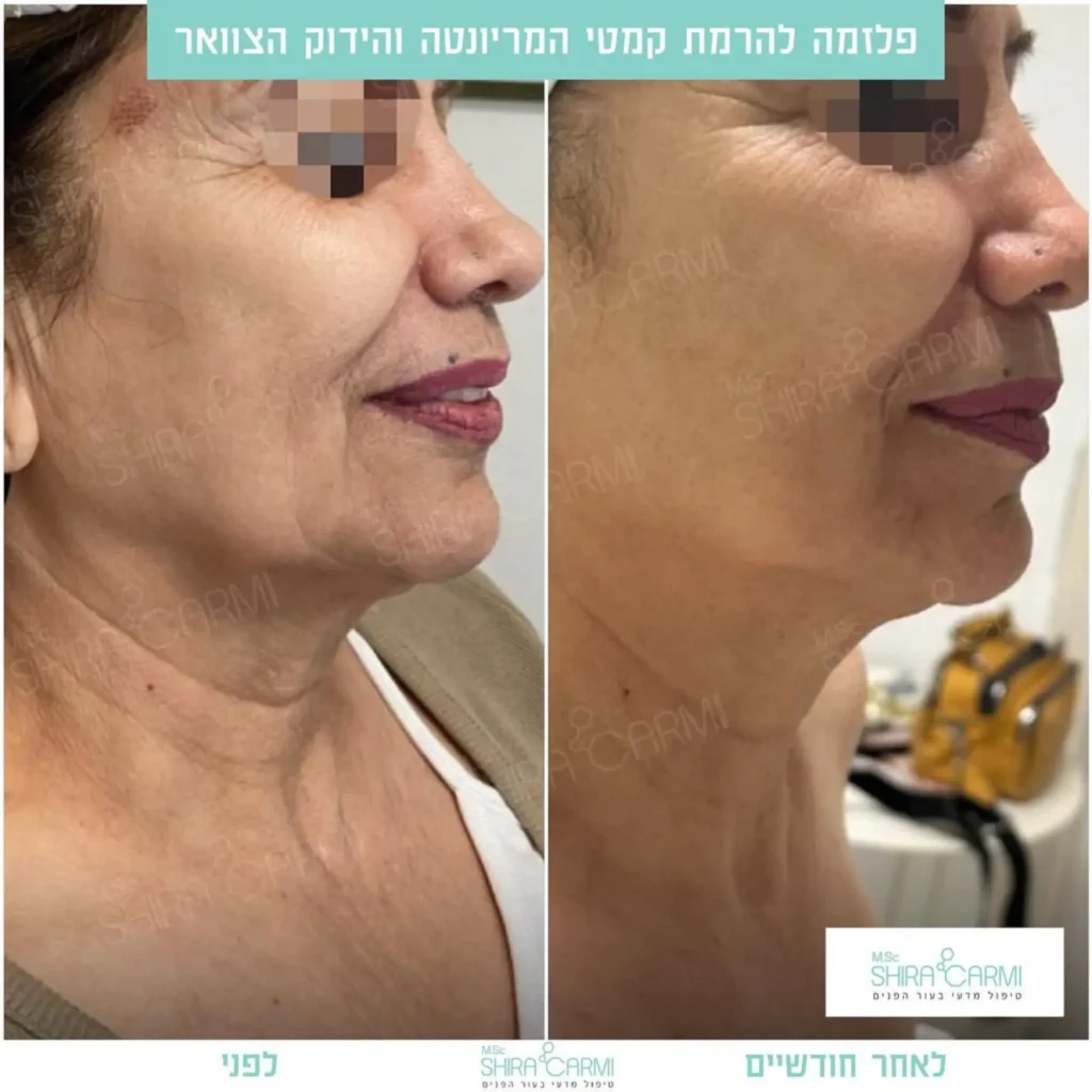 טיפול פלזמה למתיחר העור לפני אחרי טיפולי פלזמה שירה כרמי קוסמטיקאית רפואית