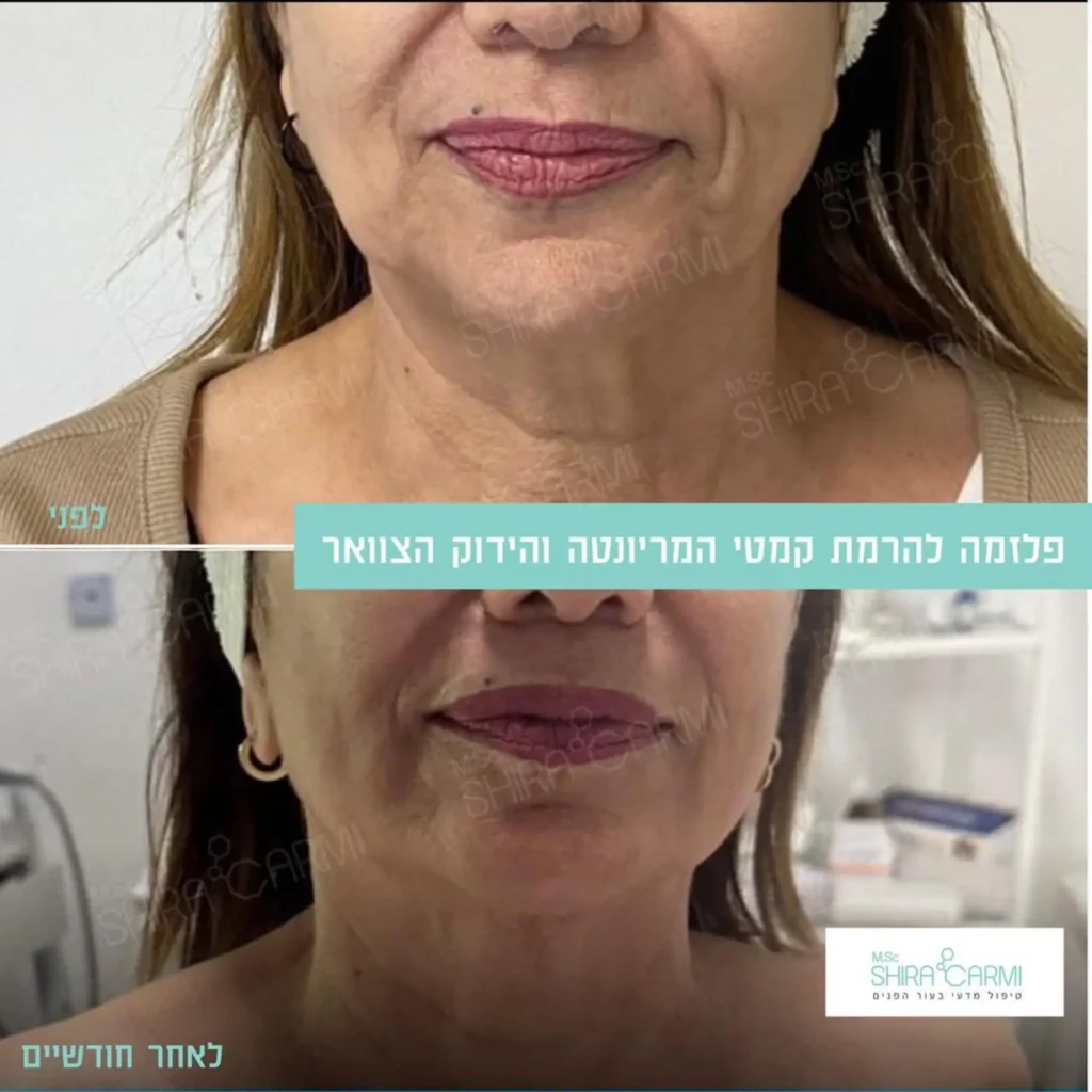 טיפול פלזמה למתיחר העור לפני אחרי טיפולי פלזמה שירה כרמי קוסמטיקאית רפואית