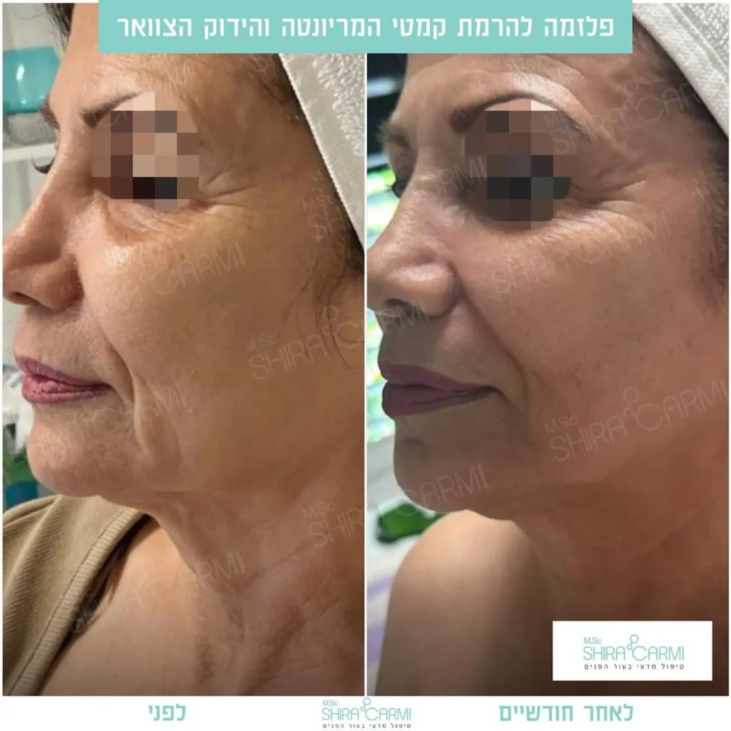 טיפול פלזמה למתיחר העור לפני אחרי טיפולי פלזמה שירה כרמי קוסמטיקאית רפואית