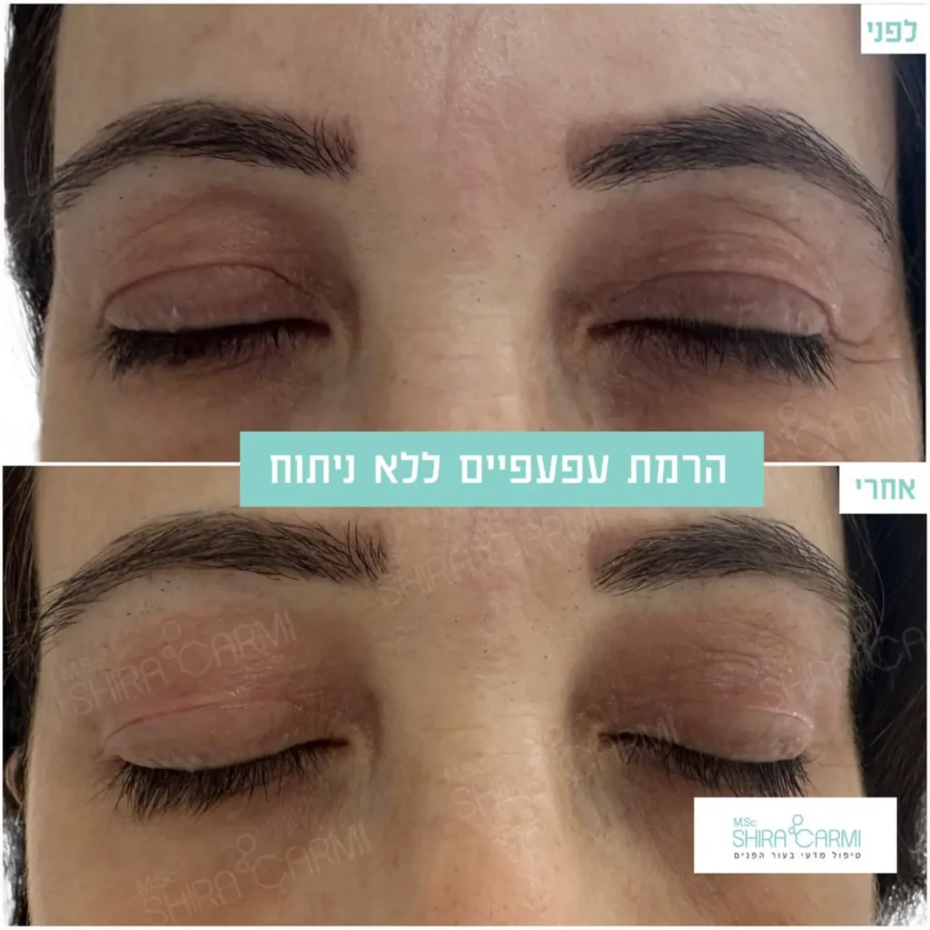 טיפול פלזמה למתיחר העור לפני אחרי טיפולי פלזמה שירה כרמי קוסמטיקאית רפואית