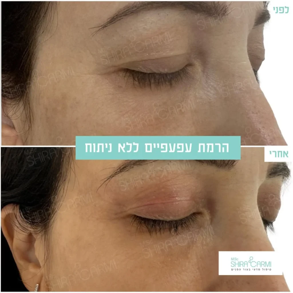 טיפול פלזמה למתיחר העור לפני אחרי טיפולי פלזמה שירה כרמי קוסמטיקאית רפואית
