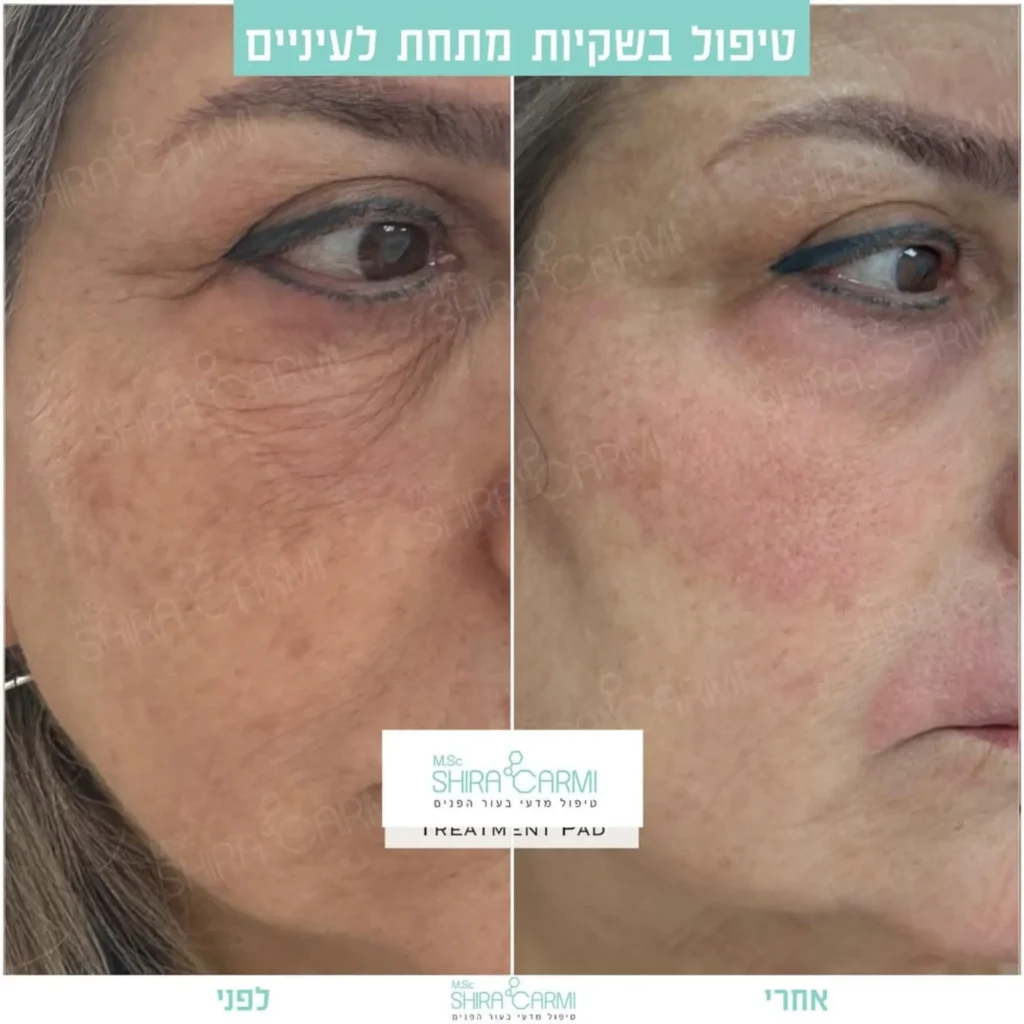 טיפול פלזמה למתיחר העור לפני אחרי טיפולי פלזמה שירה כרמי קוסמטיקאית רפואית