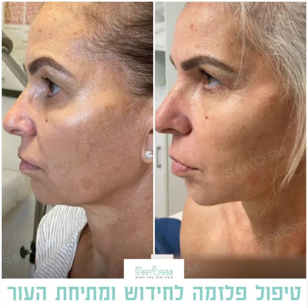 טיפול פלזמה למתיחר העור לפני אחרי טיפולי פלזמה שירה כרמי קוסמטיקאית רפואית