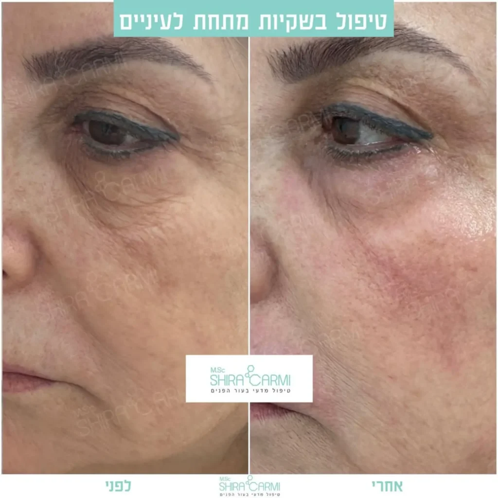 טיפול פלזמה למתיחר העור לפני אחרי טיפולי פלזמה שירה כרמי קוסמטיקאית רפואית