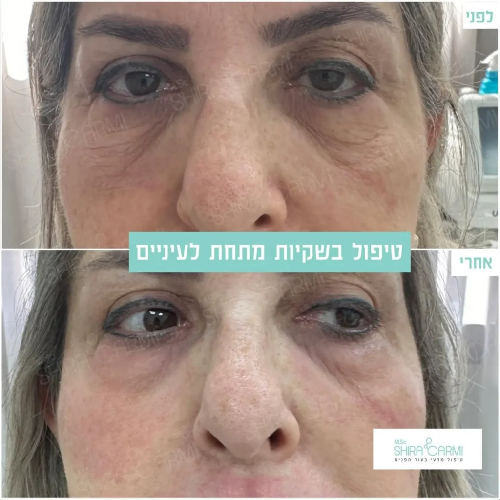 טיפול פלזמה למתיחר העור לפני אחרי טיפולי פלזמה שירה כרמי קוסמטיקאית רפואית