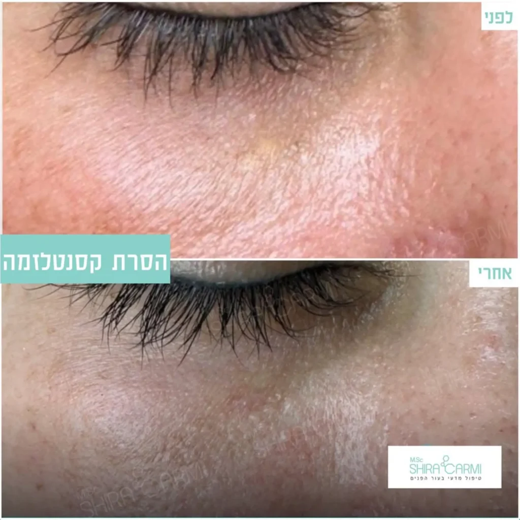 טיפול פלזמה למתיחר העור לפני אחרי טיפולי פלזמה שירה כרמי קוסמטיקאית רפואית