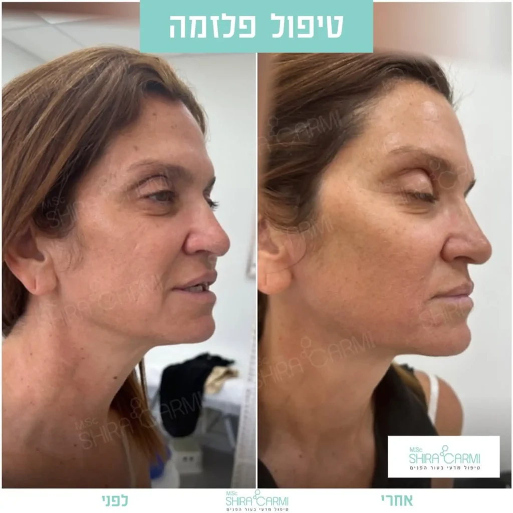 טיפול פלזמה למתיחר העור לפני אחרי טיפולי פלזמה שירה כרמי קוסמטיקאית רפואית