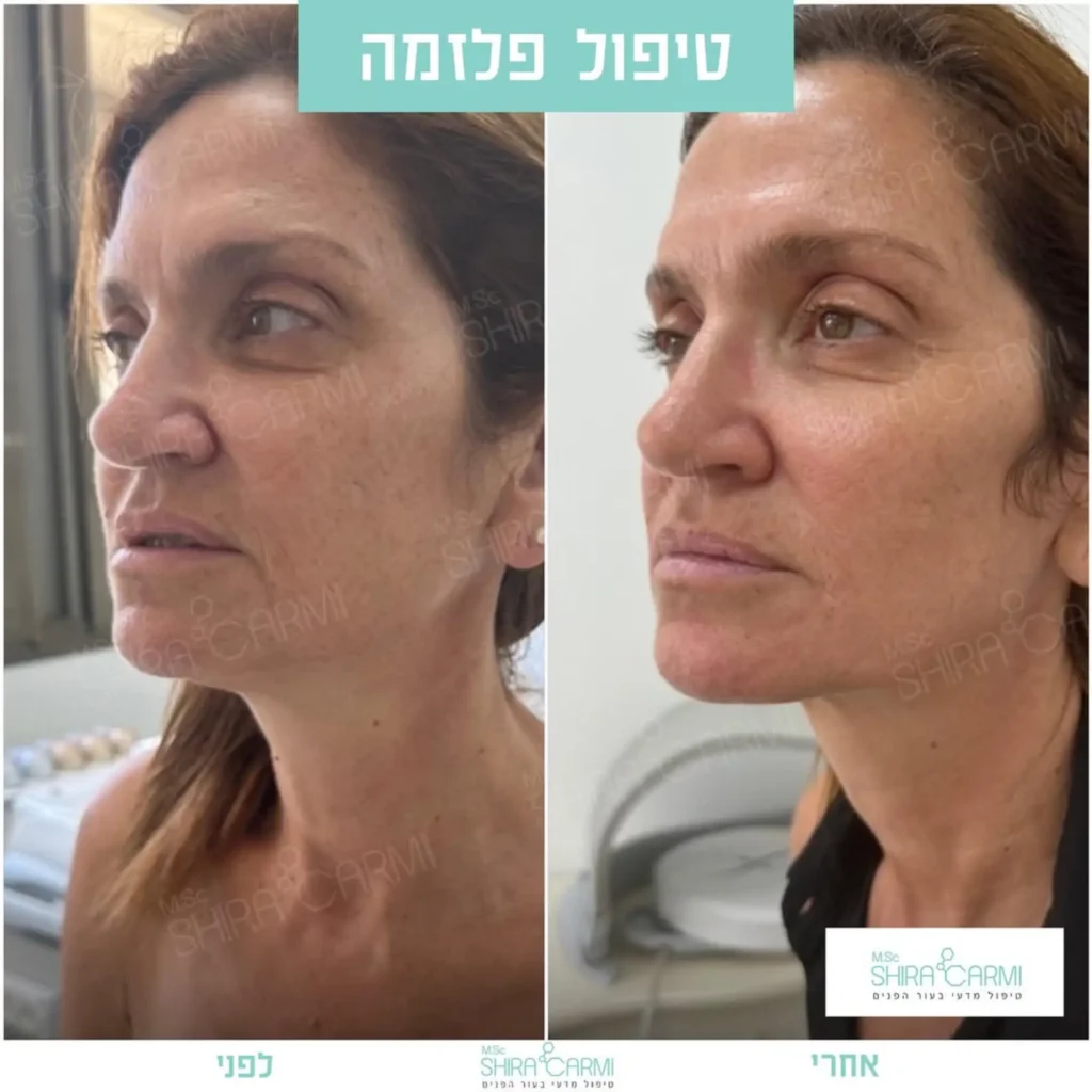 טיפול פלזמה למתיחר העור לפני אחרי טיפולי פלזמה שירה כרמי קוסמטיקאית רפואית
