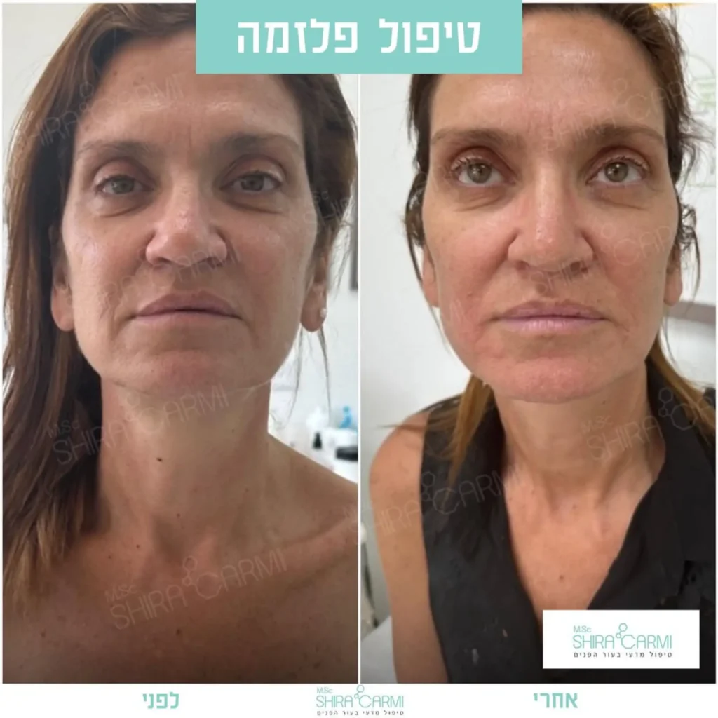 טיפול פלזמה למתיחר העור לפני אחרי טיפולי פלזמה שירה כרמי קוסמטיקאית רפואית