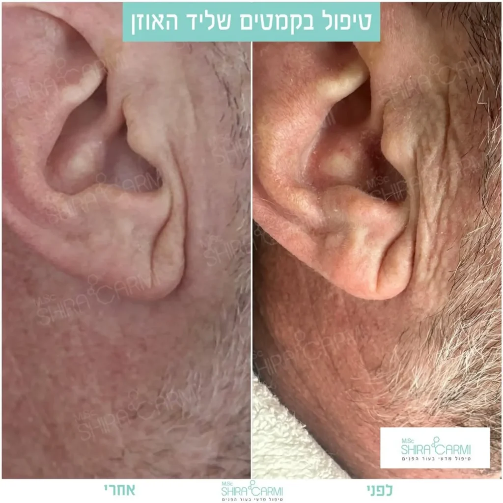 טיפול פלזמה למתיחר העור לפני אחרי טיפולי פלזמה שירה כרמי קוסמטיקאית רפואית