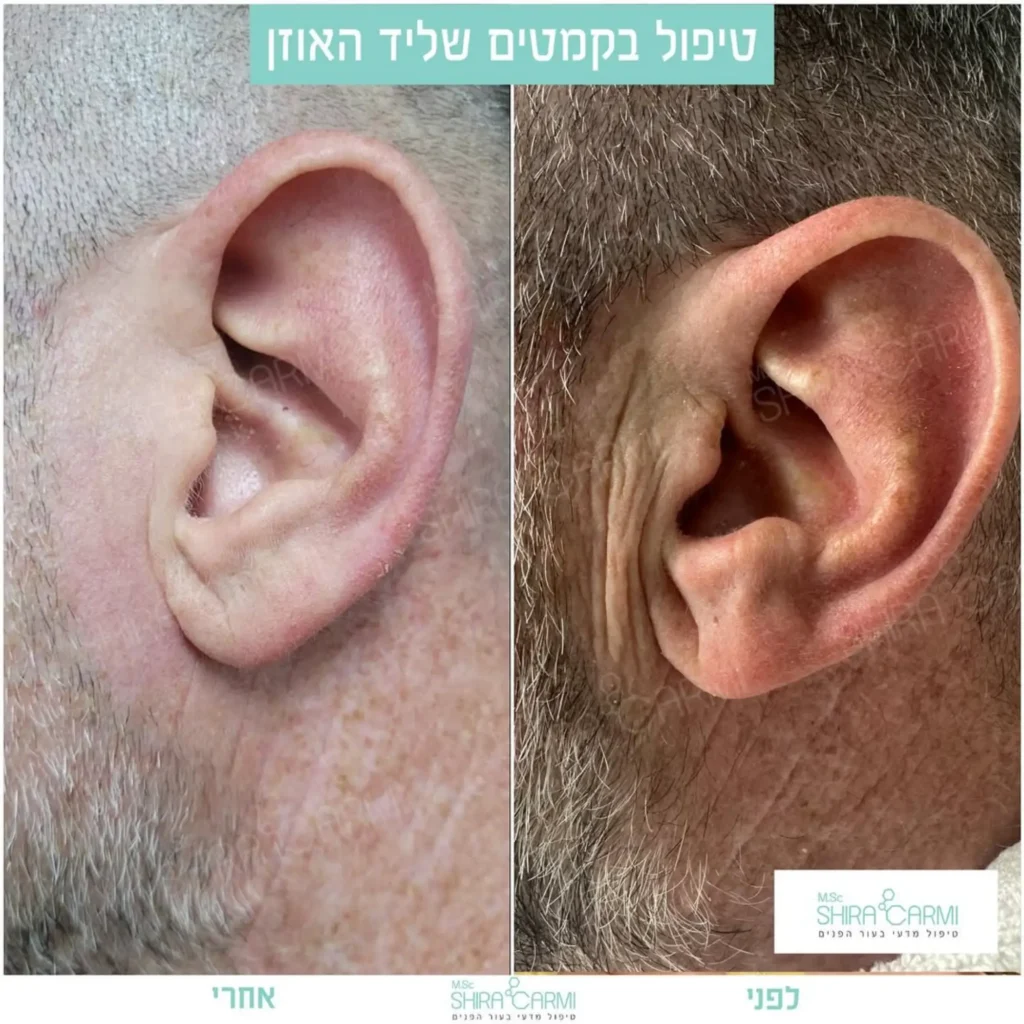 טיפול פלזמה למתיחר העור לפני אחרי טיפולי פלזמה שירה כרמי קוסמטיקאית רפואית