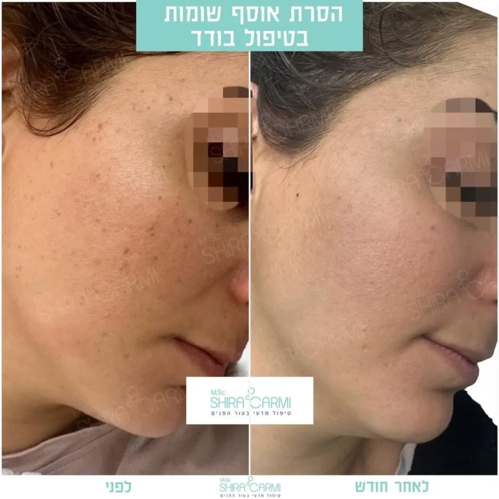 טיפול פלזמה למתיחר העור לפני אחרי טיפולי פלזמה שירה כרמי קוסמטיקאית רפואית