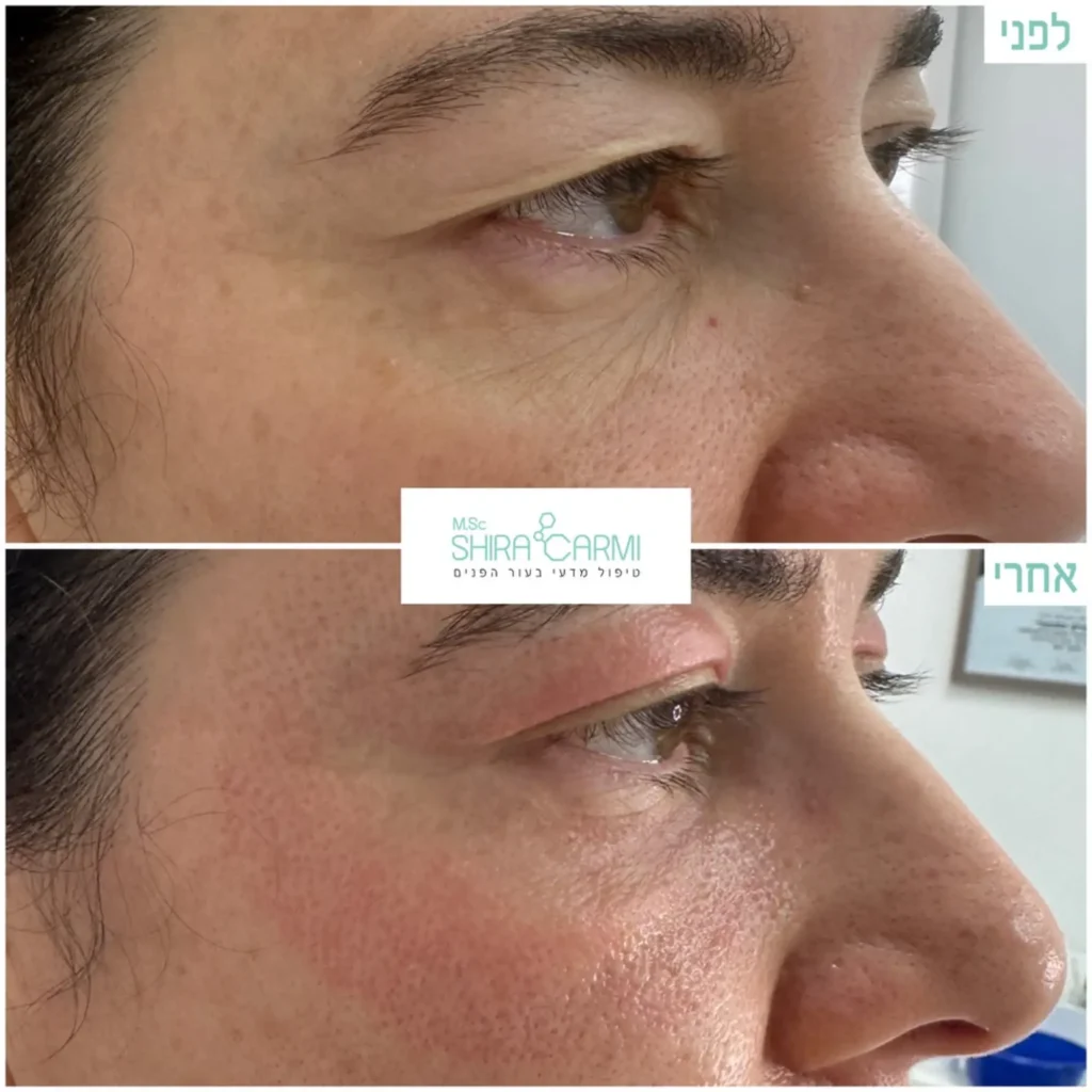 טיפול פלזמה למתיחר העור לפני אחרי טיפולי פלזמה שירה כרמי קוסמטיקאית רפואית