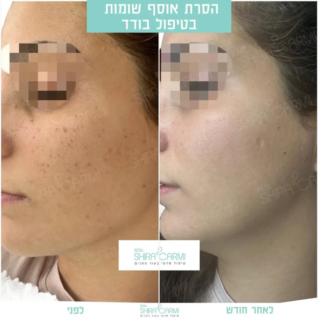 טיפול פלזמה למתיחר העור לפני אחרי טיפולי פלזמה שירה כרמי קוסמטיקאית רפואית