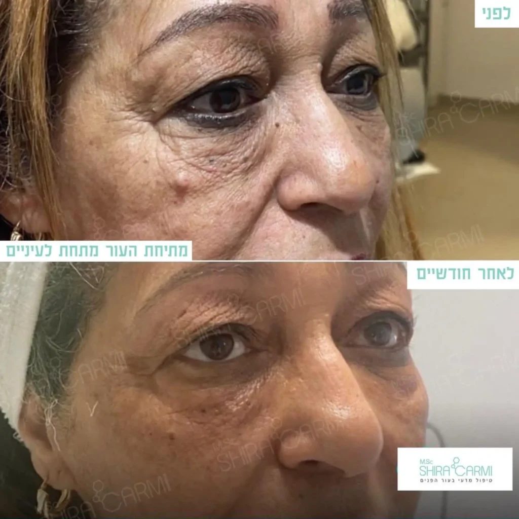 טיפול פלזמה למתיחר העור לפני אחרי טיפולי פלזמה שירה כרמי קוסמטיקאית רפואית