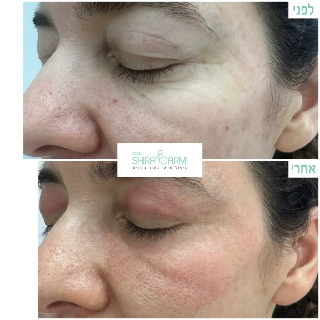 טיפול פלזמה למתיחר העור לפני אחרי טיפולי פלזמה שירה כרמי קוסמטיקאית רפואית