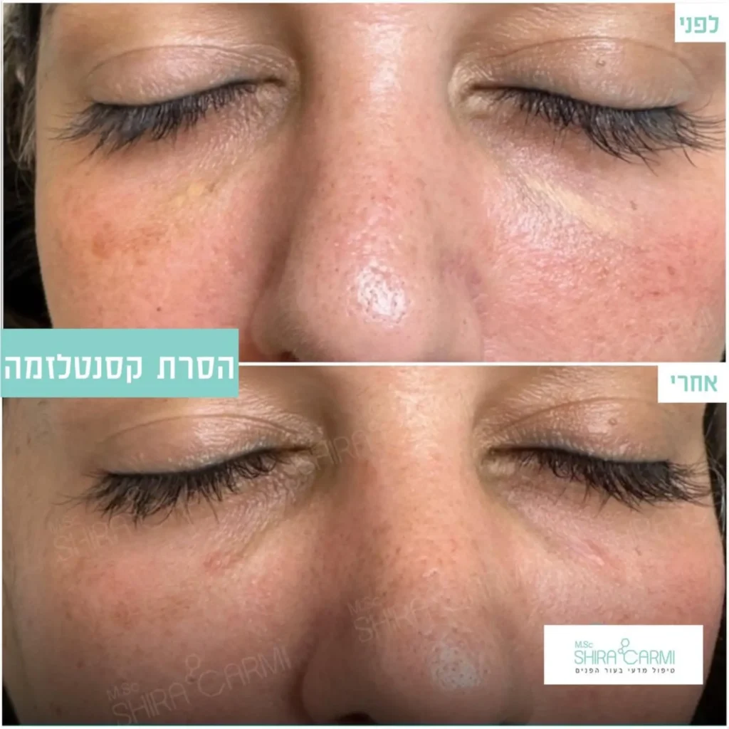 טיפול פלזמה למתיחר העור לפני אחרי טיפולי פלזמה שירה כרמי קוסמטיקאית רפואית