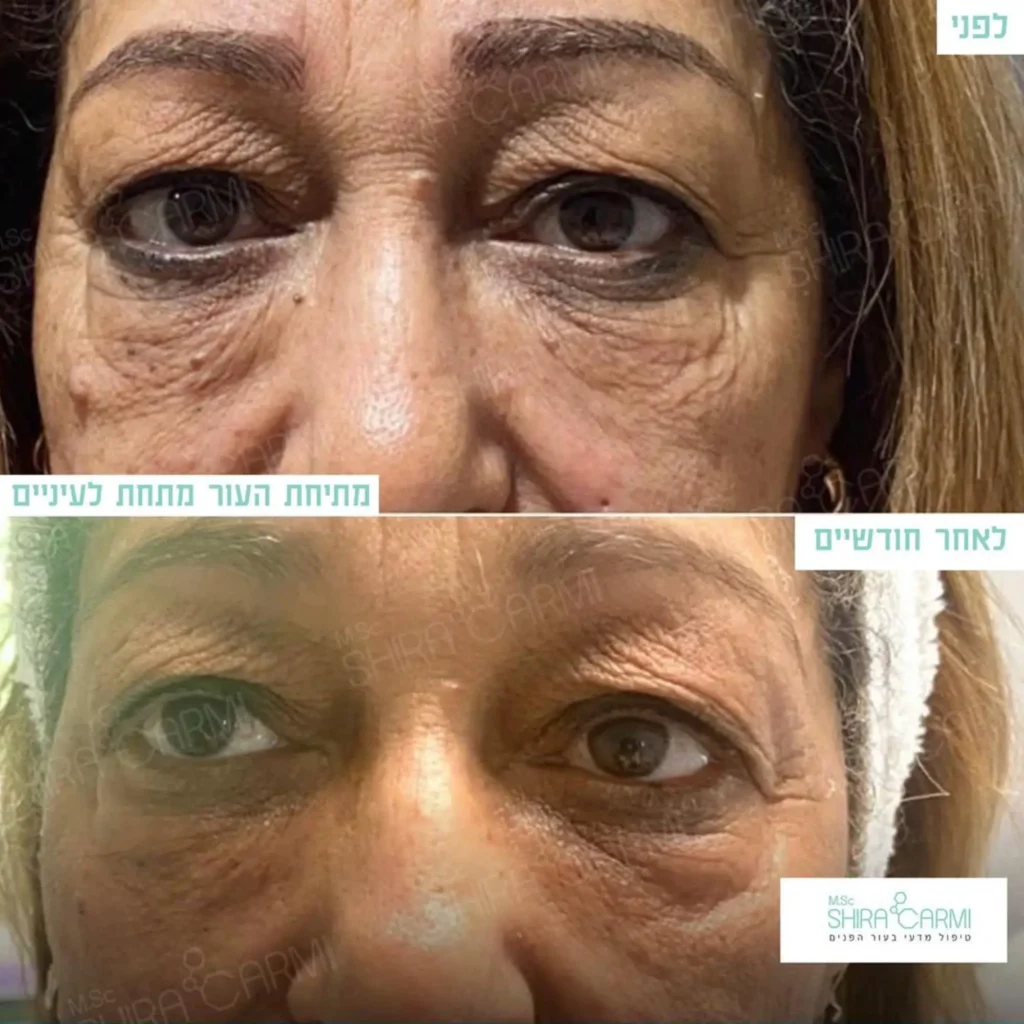 טיפול פלזמה למתיחר העור לפני אחרי טיפולי פלזמה שירה כרמי קוסמטיקאית רפואית