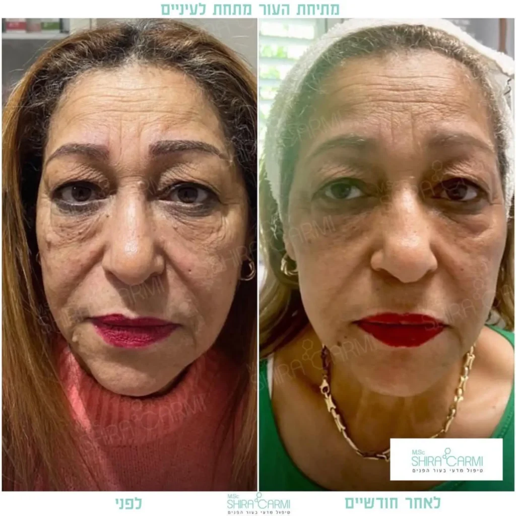 טיפול פלזמה למתיחר העור לפני אחרי טיפולי פלזמה שירה כרמי קוסמטיקאית רפואית