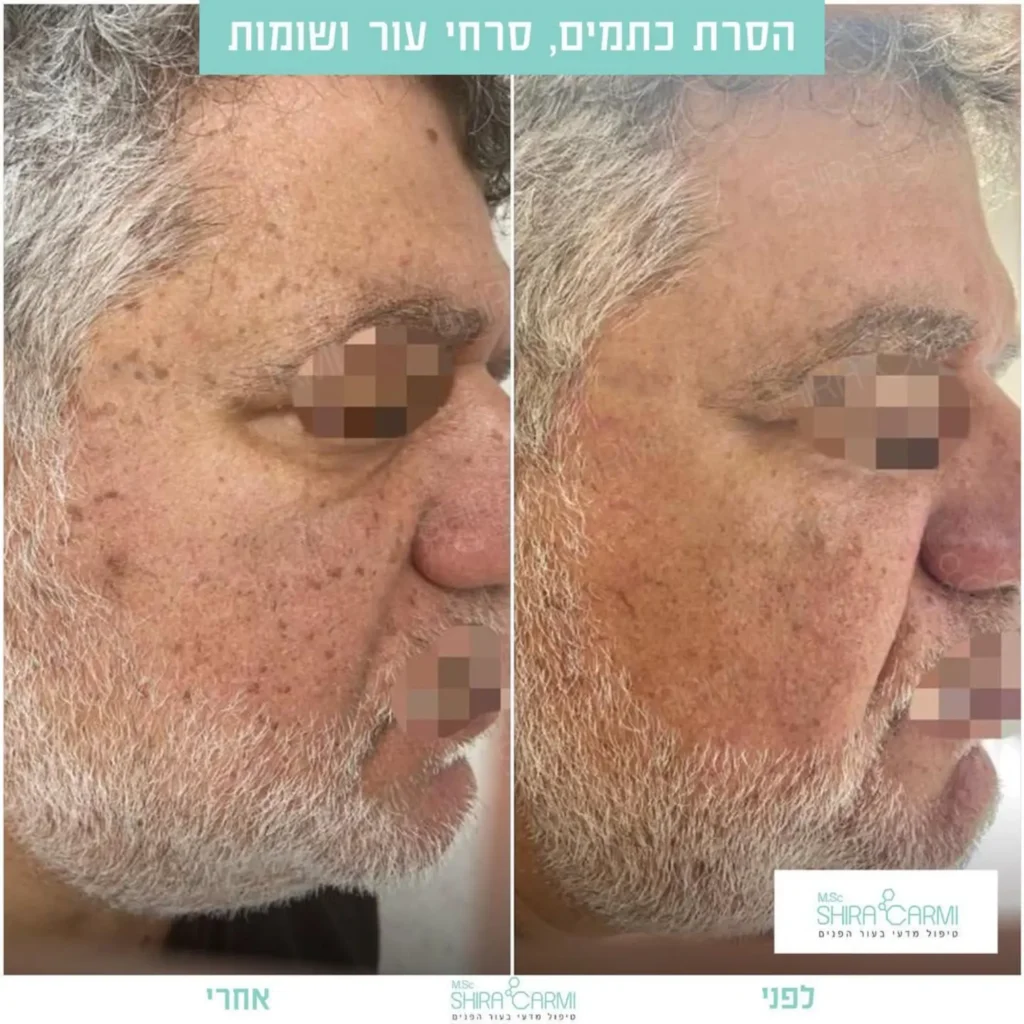 טיפול פלזמה למתיחר העור לפני אחרי טיפולי פלזמה שירה כרמי קוסמטיקאית רפואית