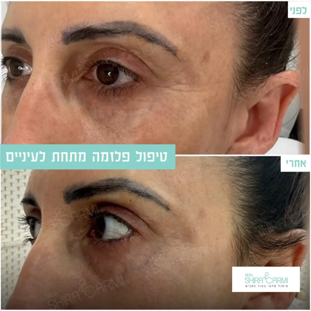 טיפול פלזמה למתיחר העור לפני אחרי טיפולי פלזמה שירה כרמי קוסמטיקאית רפואית