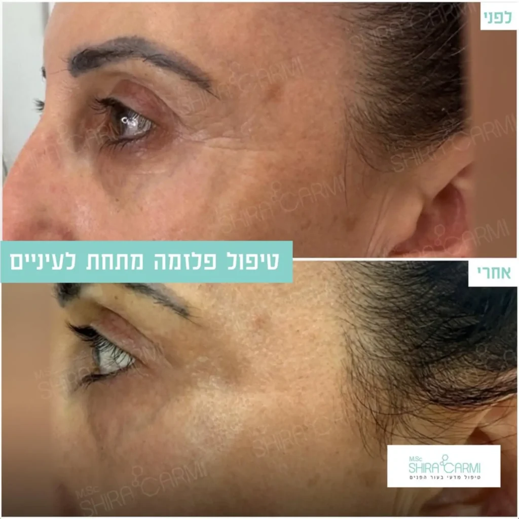 טיפול פלזמה למתיחר העור לפני אחרי טיפולי פלזמה שירה כרמי קוסמטיקאית רפואית
