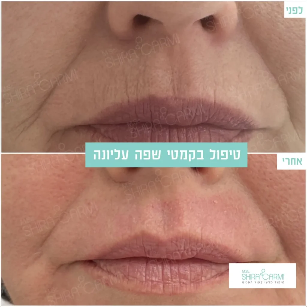 טיפול פלזמה למתיחר העור לפני אחרי טיפולי פלזמה שירה כרמי קוסמטיקאית רפואית (36)