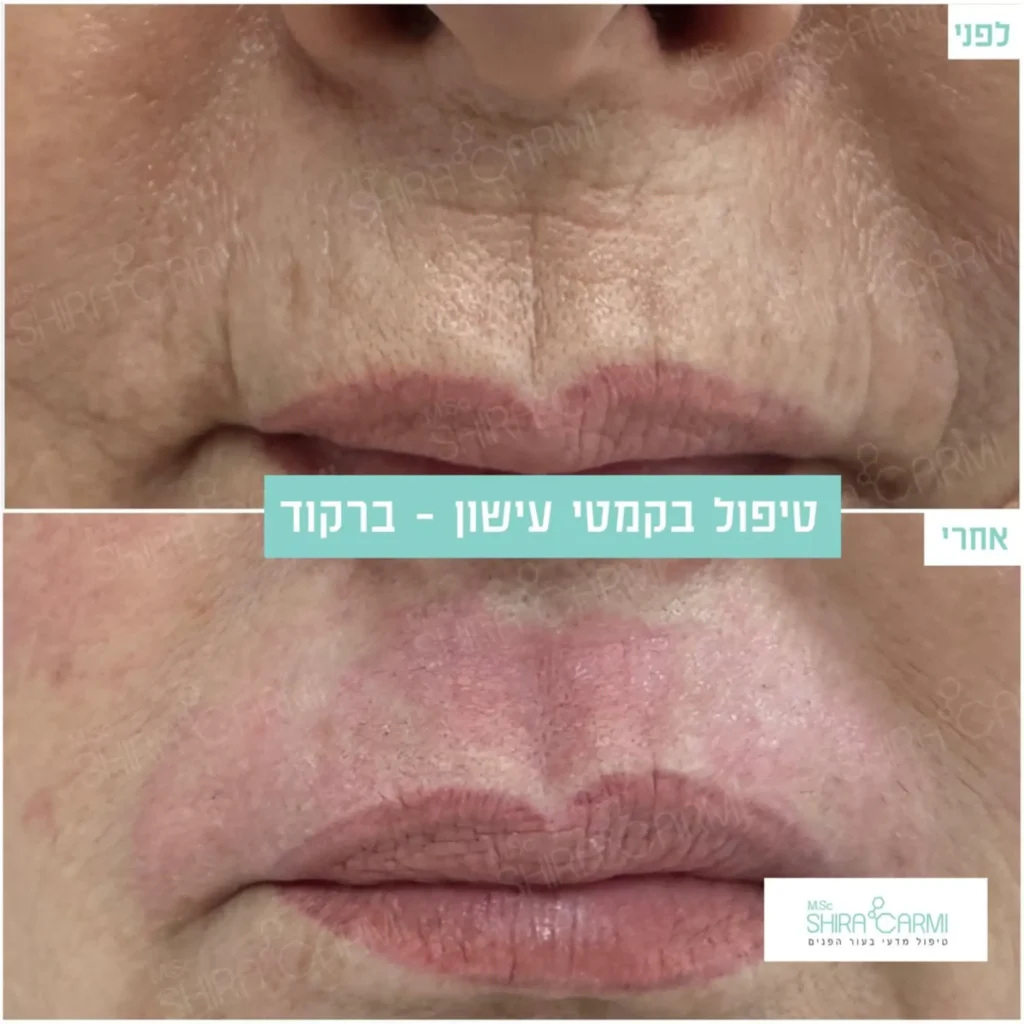 טיפול פלזמה למתיחר העור לפני אחרי טיפולי פלזמה שירה כרמי קוסמטיקאית רפואית