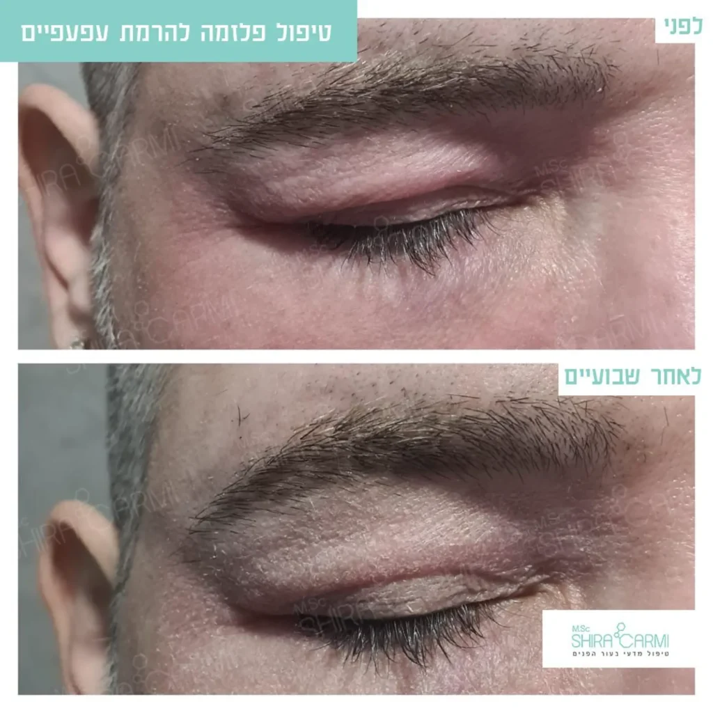 טיפול פלזמה למתיחר העור לפני אחרי טיפולי פלזמה שירה כרמי קוסמטיקאית רפואית