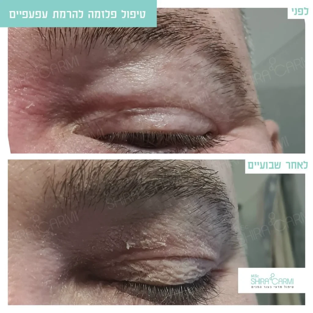 טיפול פלזמה למתיחר העור לפני אחרי טיפולי פלזמה שירה כרמי קוסמטיקאית רפואית