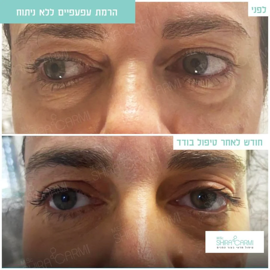 טיפול פלזמה למתיחר העור לפני אחרי טיפולי פלזמה שירה כרמי קוסמטיקאית רפואית