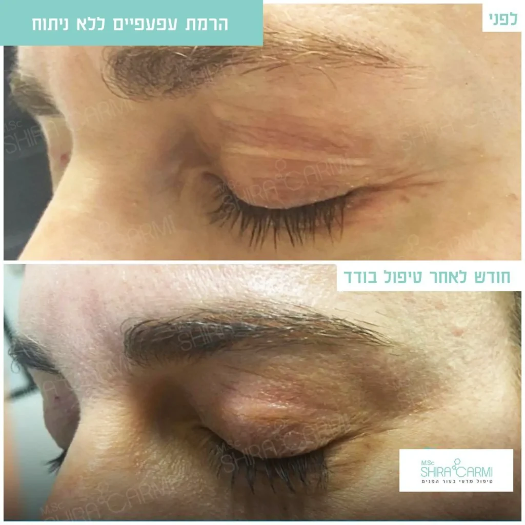 טיפול פלזמה למתיחר העור לפני אחרי טיפולי פלזמה שירה כרמי קוסמטיקאית רפואית