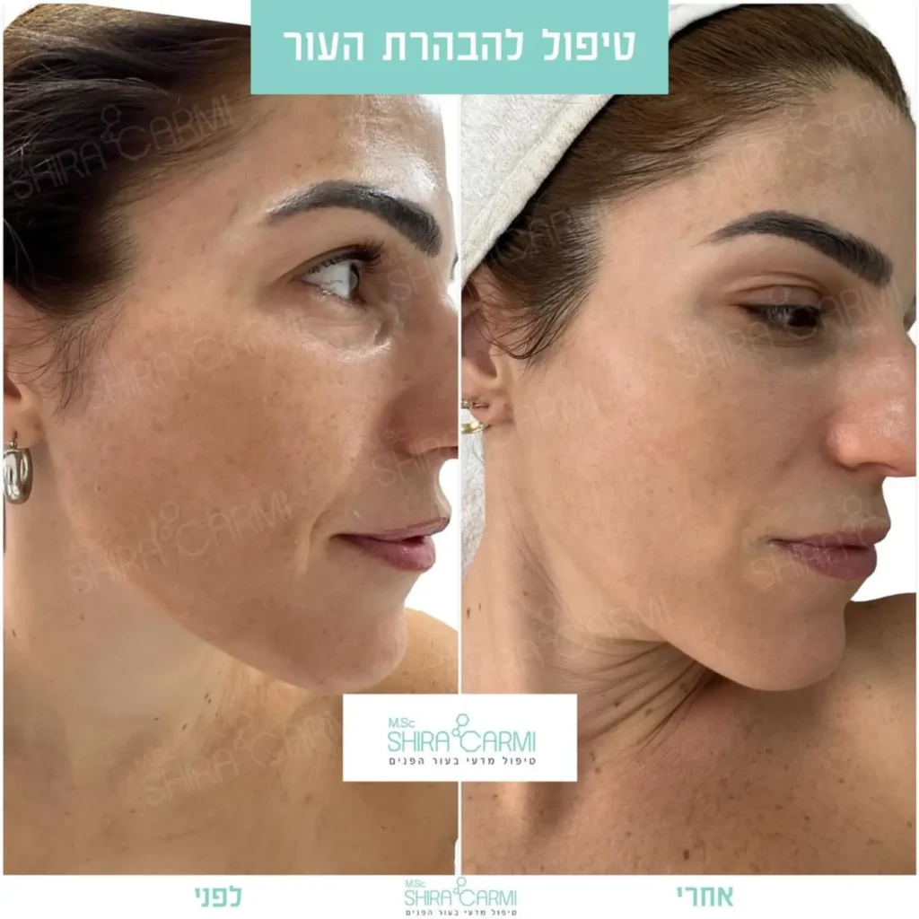 טיפול פנים פיגמנטציה וכתמי עור העלמת כתמים בעור הפנים שירה כרמי קרית אונו