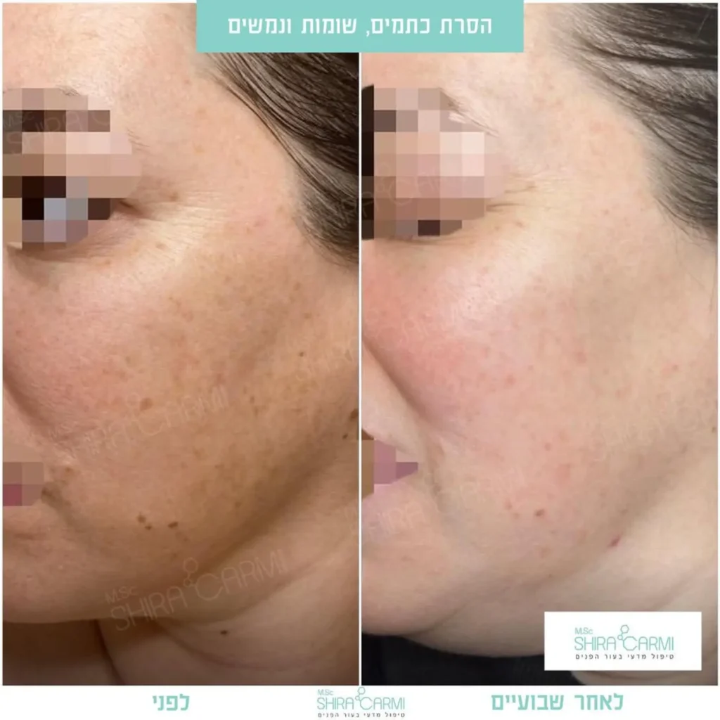 טיפול פנים פיגמנטציה וכתמי עור העלמת כתמים בעור הפנים שירה כרמי קרית אונו