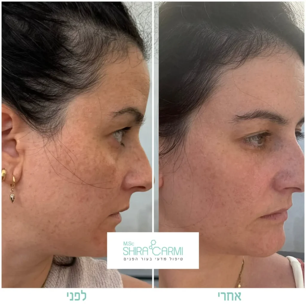טיפול פנים פיגמנטציה וכתמי עור העלמת כתמים בעור הפנים שירה כרמי קרית אונו