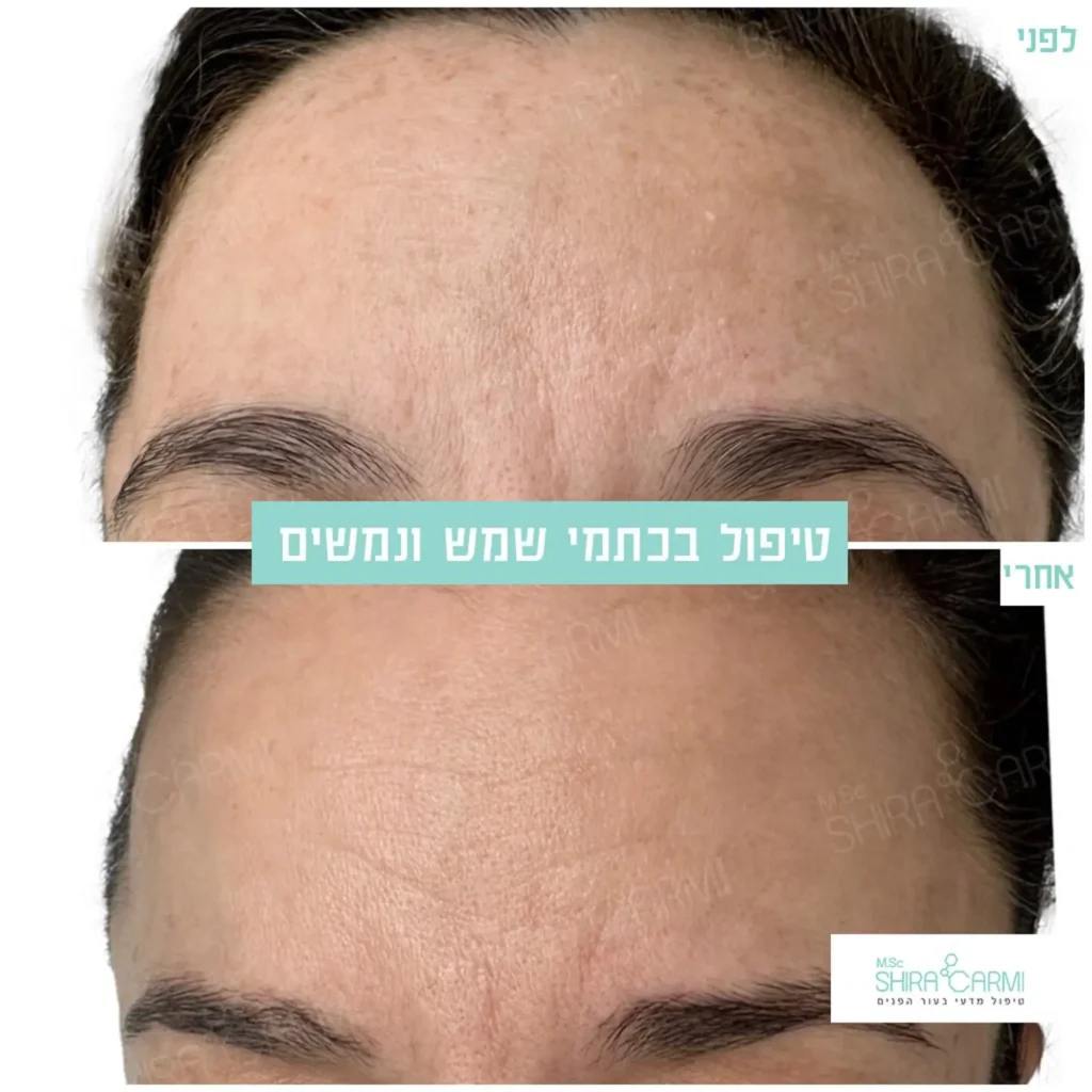 טיפול פנים פיגמנטציה וכתמי עור העלמת כתמים בעור הפנים שירה כרמי קרית אונו