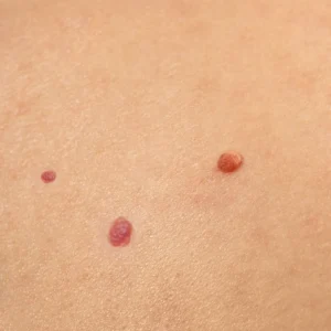 שרי המנגיומה הסרה קוסמטיקאית רפואית שירה כרמי