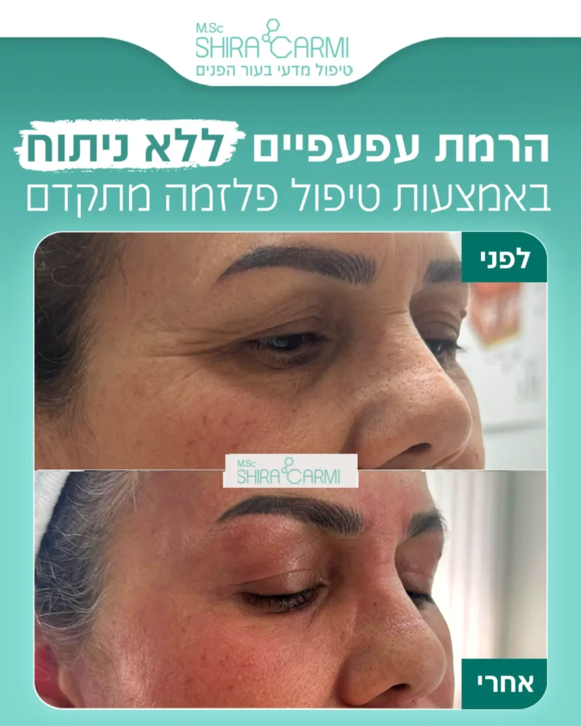 טיפול פלזמה הרמת עפעפיים ללא ניתוח שירה כרמי