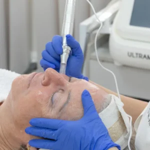 טיפול פנים מיקרונידלינג שירה כרמי גני תקווה