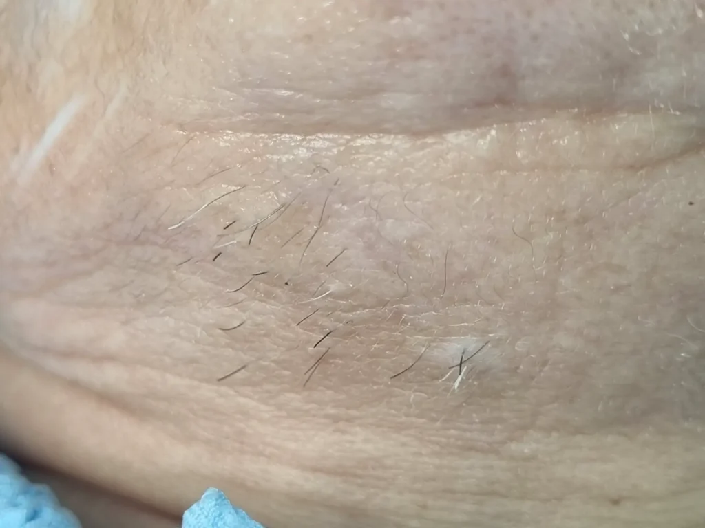 הסרת שיער בפנים ללא גילוח שילוב מנצח של IPL ואפילציה