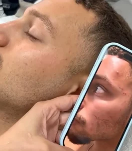 טיפול באקנה בקליניקה של שירה כרמי בקני תקווה תוצאות לאחר מספר טיפולים