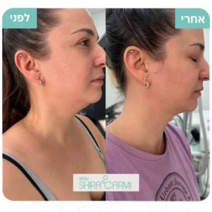 המסת שומן בסנטר שירה כרמי גני תקוה