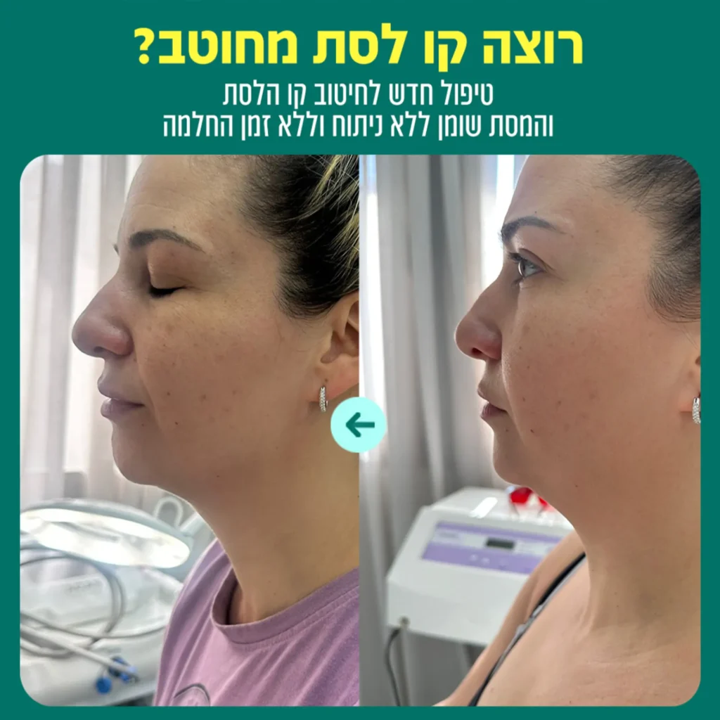 המסת שומן בסנטר שירה כרמי גני תקוה